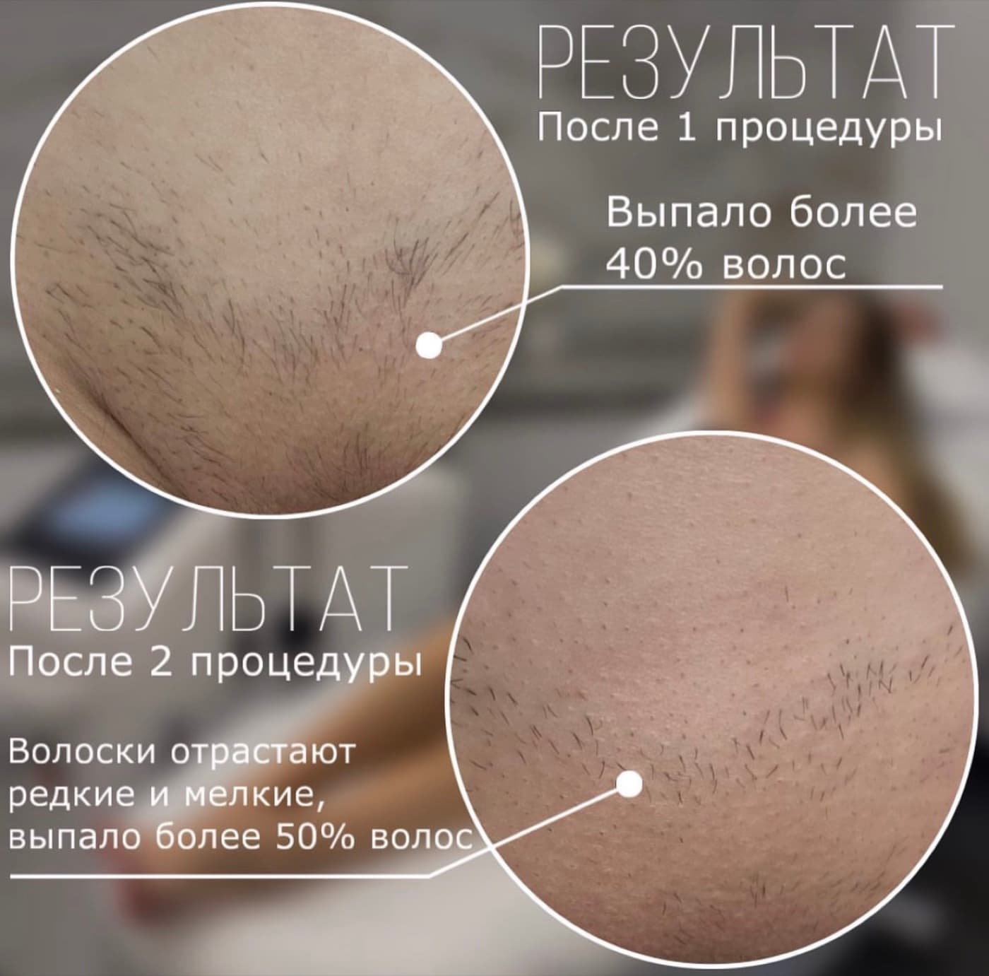 Динамика результата лазерной эпиляции после одной и двух процедур